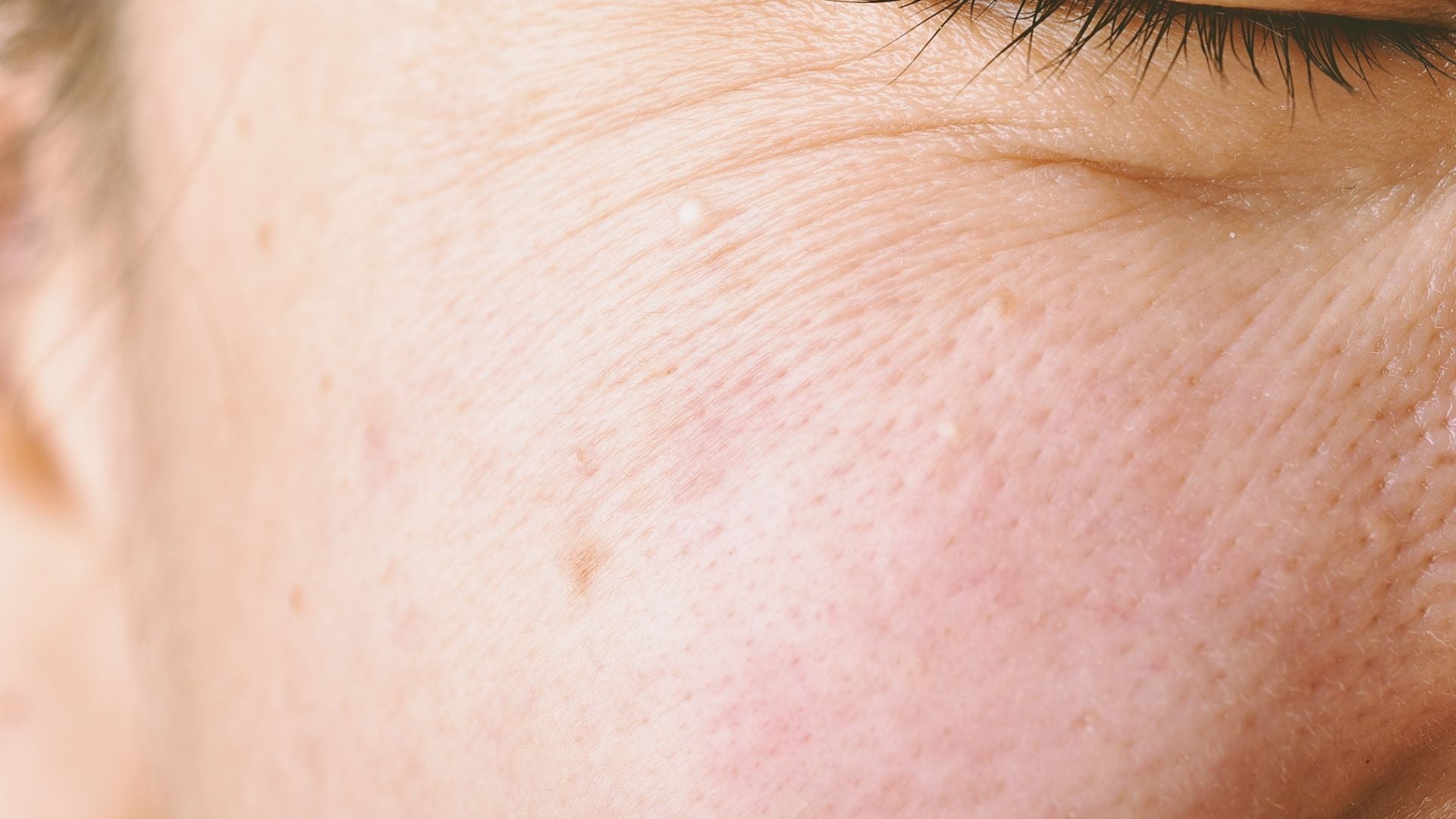DEHYDRERET HUD - Sara Lorentsen Skin Expert