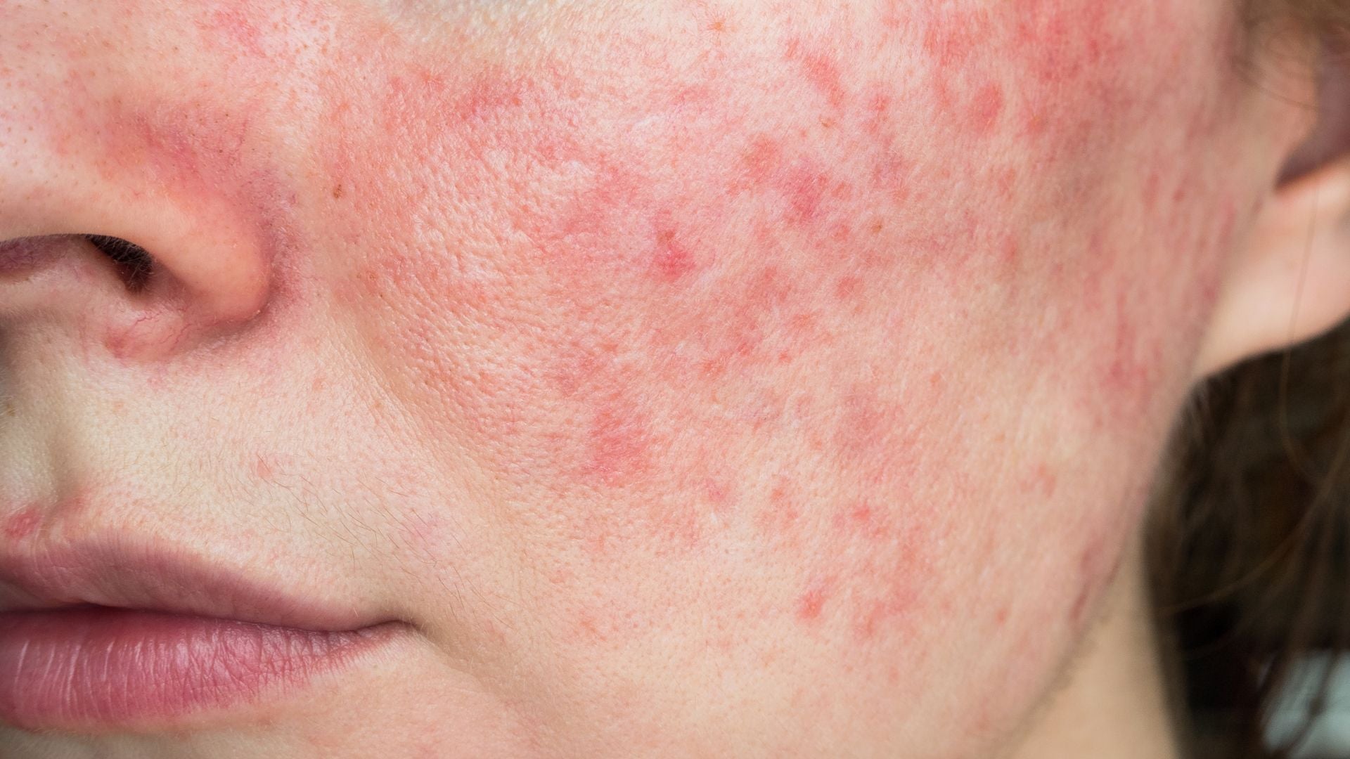 ROSACEA - Sara Lorentsen Skin Expert