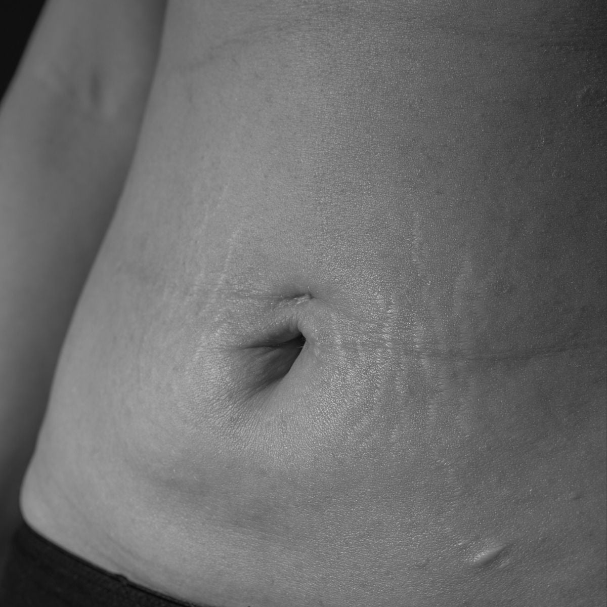 Cellulite & Firming-behandling af maven hos Obsido Studio i Vejle