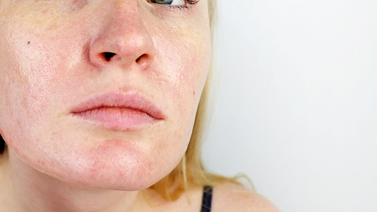 Skincare for Oily Skin | Obsido